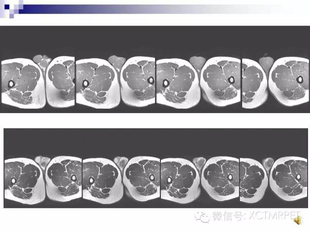 【PPT】睾丸生殖细胞肿瘤的磁共振诊断