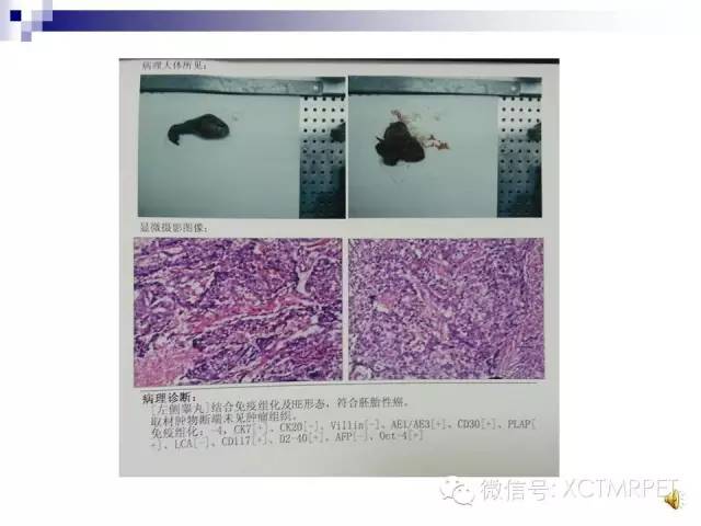 【PPT】睾丸生殖细胞肿瘤的磁共振诊断