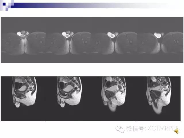 【PPT】睾丸生殖细胞肿瘤的磁共振诊断