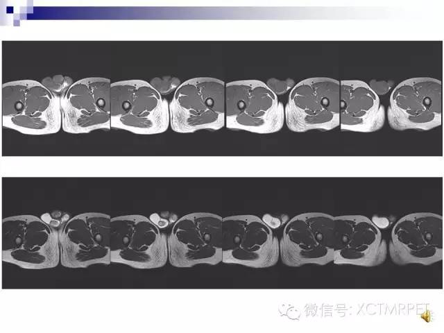 【PPT】睾丸生殖细胞肿瘤的磁共振诊断