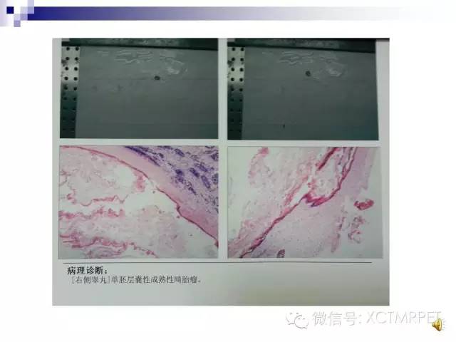 【PPT】睾丸生殖细胞肿瘤的磁共振诊断
