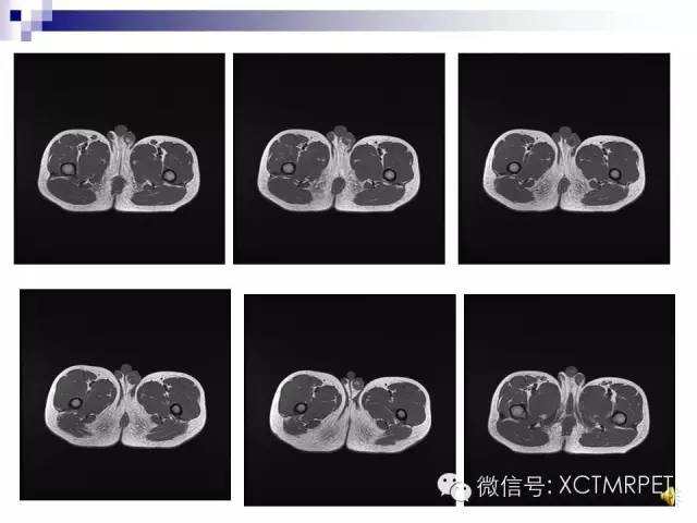 【PPT】睾丸生殖细胞肿瘤的磁共振诊断