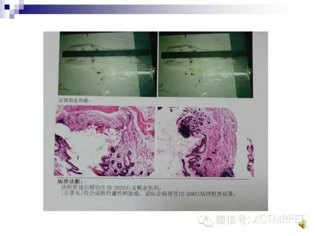 【PPT】睾丸生殖细胞肿瘤的磁共振诊断