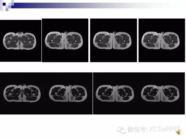 【PPT】睾丸生殖细胞肿瘤的磁共振诊断