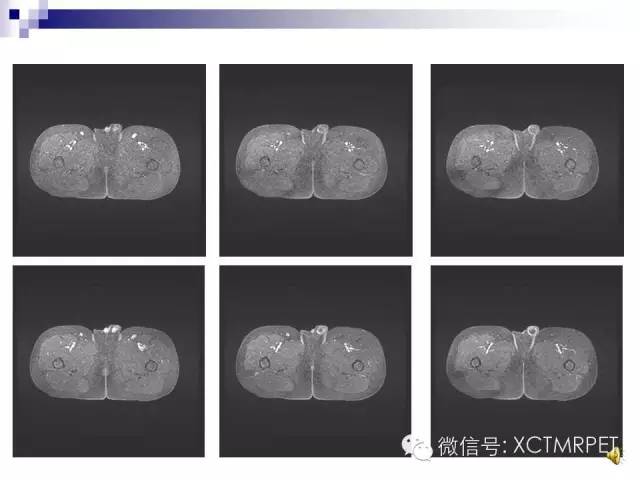 【PPT】睾丸生殖细胞肿瘤的磁共振诊断