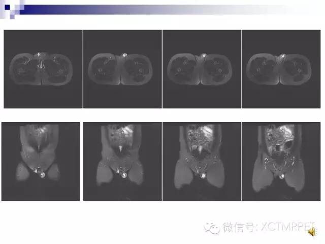 【PPT】睾丸生殖细胞肿瘤的磁共振诊断