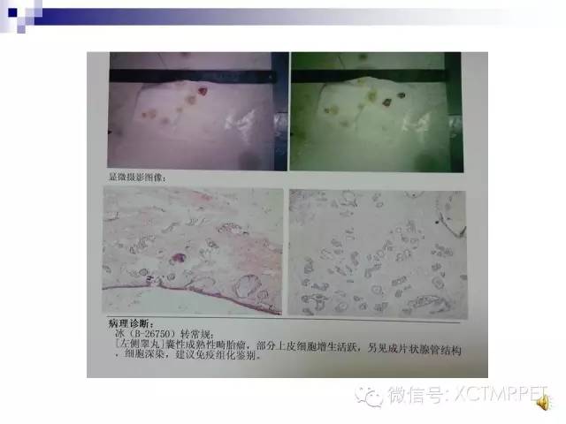 【PPT】睾丸生殖细胞肿瘤的磁共振诊断