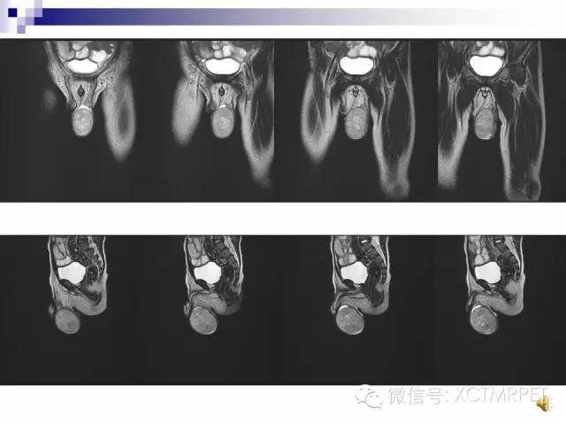 【PPT】睾丸生殖细胞肿瘤的磁共振诊断