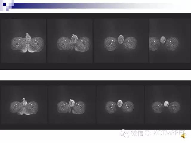 【PPT】睾丸生殖细胞肿瘤的磁共振诊断