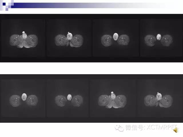 【PPT】睾丸生殖细胞肿瘤的磁共振诊断