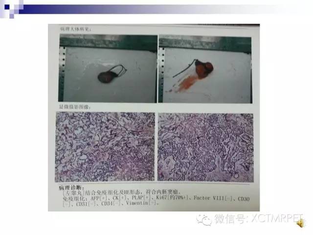 【PPT】睾丸生殖细胞肿瘤的磁共振诊断