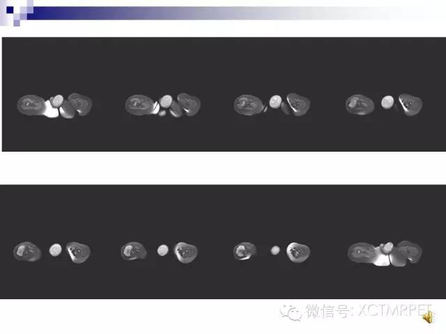 【PPT】睾丸生殖细胞肿瘤的磁共振诊断