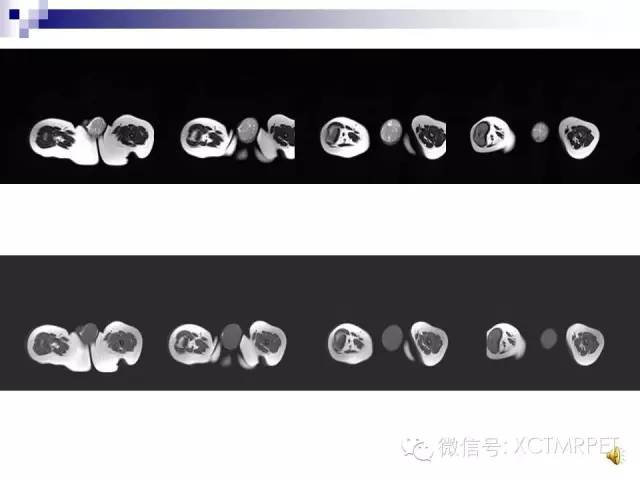 【PPT】睾丸生殖细胞肿瘤的磁共振诊断