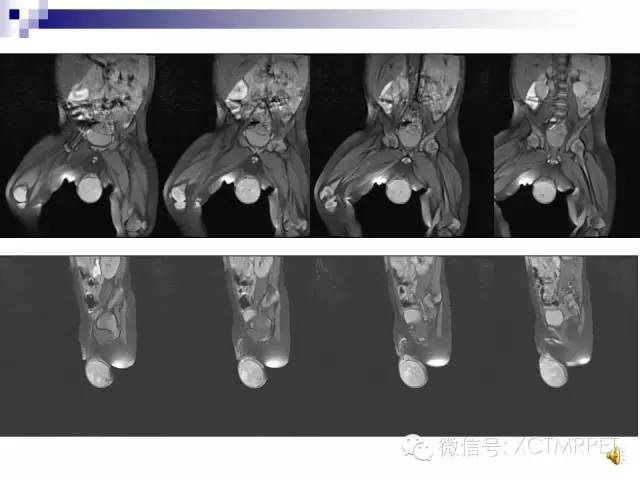【PPT】睾丸生殖细胞肿瘤的磁共振诊断