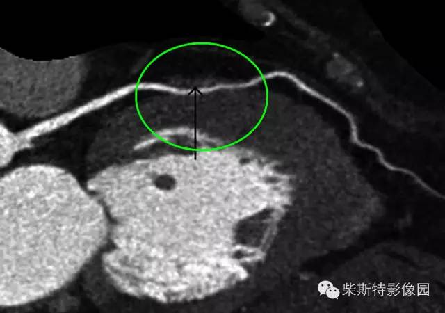 冠状动脉心肌桥 冠状动脉心肌桥
