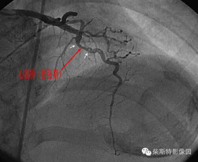 冠状动脉心肌桥 冠状动脉心肌桥