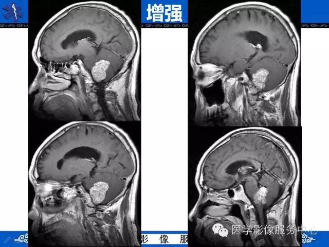 【病例】四脑室脉络丛乳头状瘤1例MR影像表现 【病例】四脑室脉络丛乳头状瘤1例MR影像表现