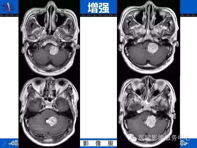 【病例】四脑室脉络丛乳头状瘤1例MR影像表现 【病例】四脑室脉络丛乳头状瘤1例MR影像表现