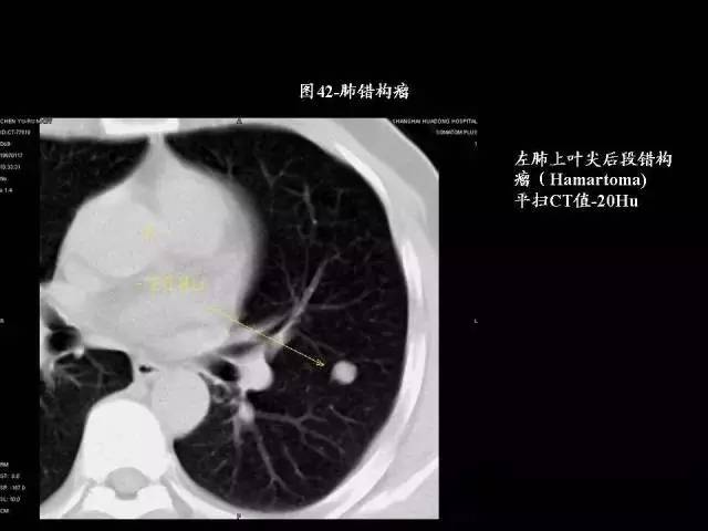 常见肺部CT病例读片