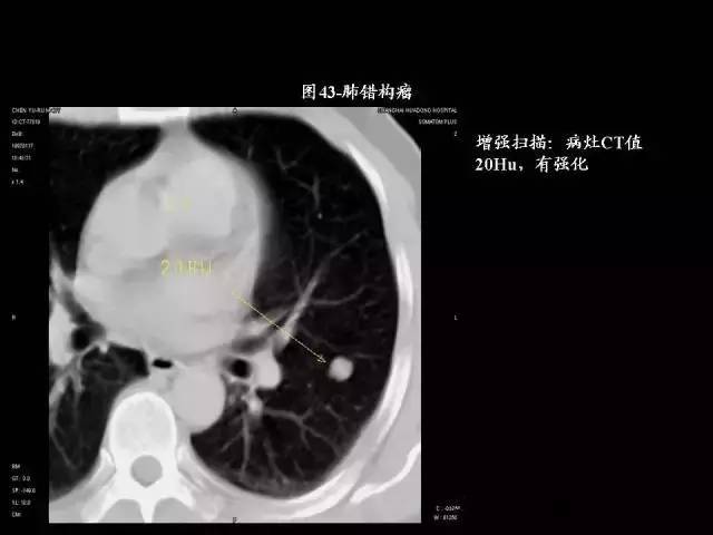 常见肺部CT病例读片
