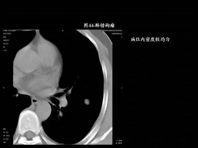 常见肺部CT病例读片
