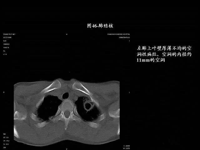 常见肺部CT病例读片
