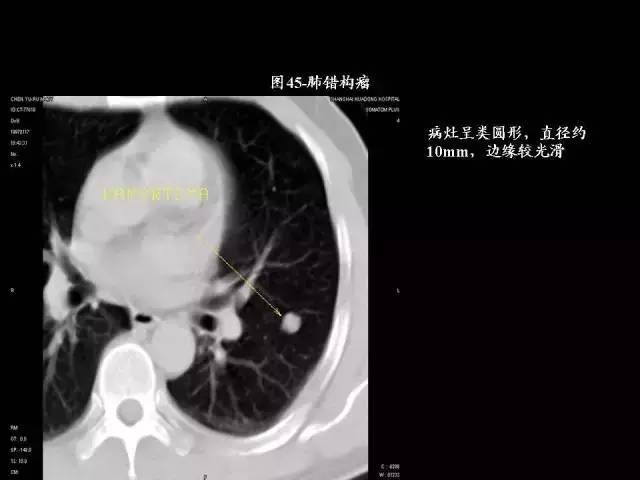 常见肺部CT病例读片