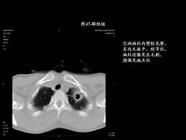 常见肺部CT病例读片