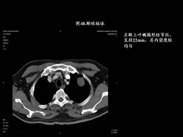 常见肺部CT病例读片