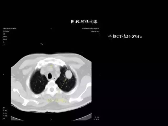 常见肺部CT病例读片