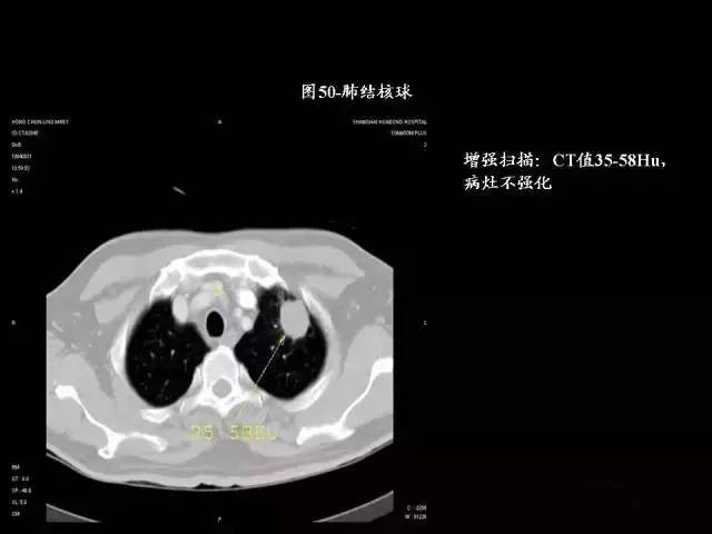 常见肺部CT病例读片