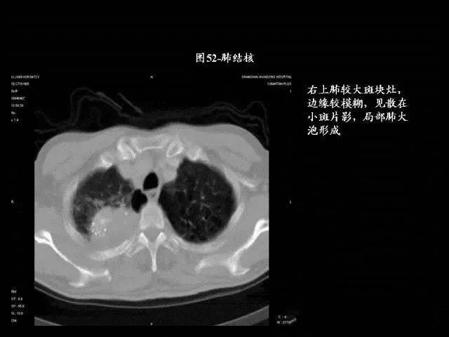 常见肺部CT病例读片