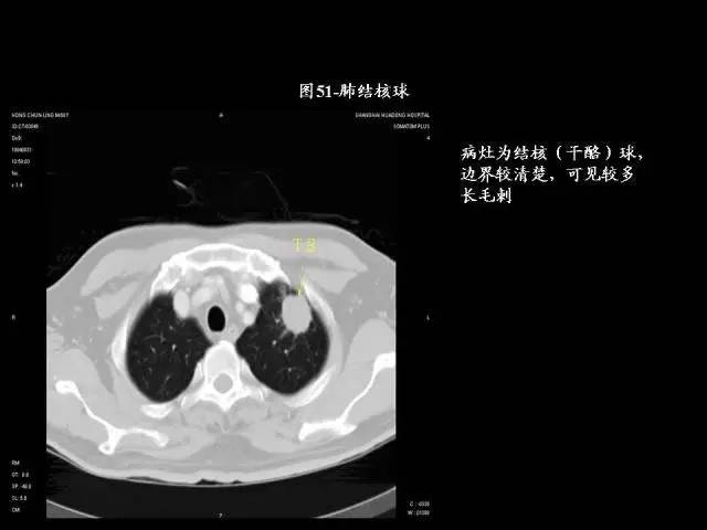 常见肺部CT病例读片