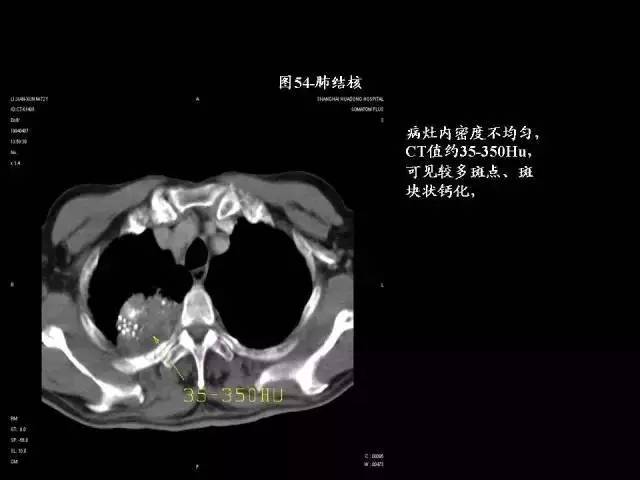 常见肺部CT病例读片