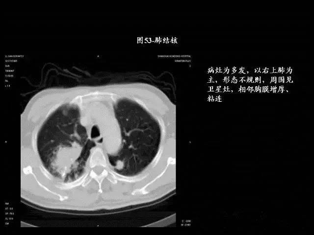 常见肺部CT病例读片