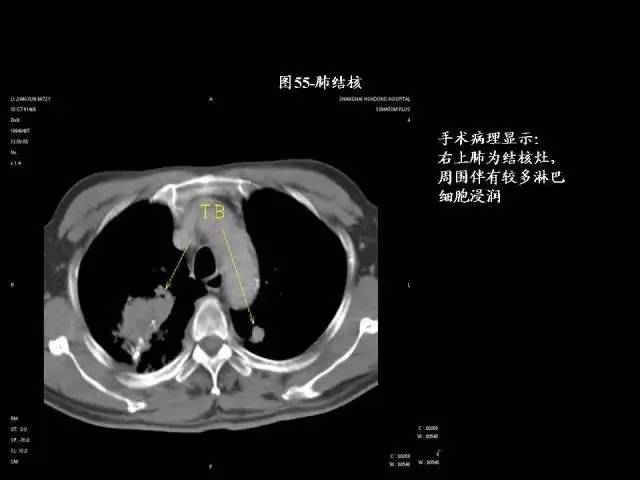 常见肺部CT病例读片