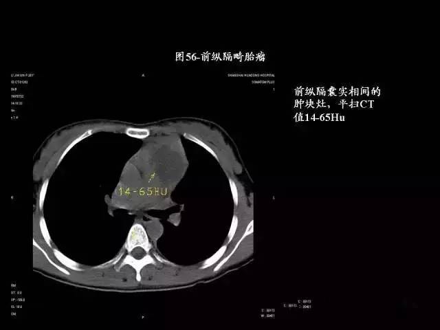常见肺部CT病例读片