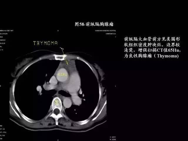 常见肺部CT病例读片