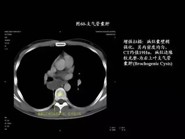 常见肺部CT病例读片