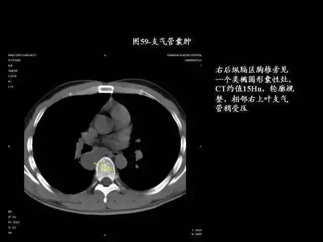 常见肺部CT病例读片