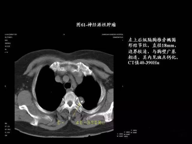 常见肺部CT病例读片