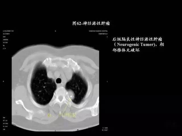 常见肺部CT病例读片