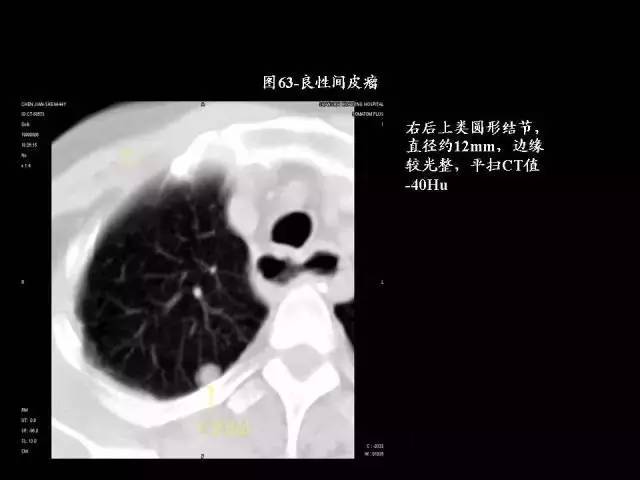 常见肺部CT病例读片