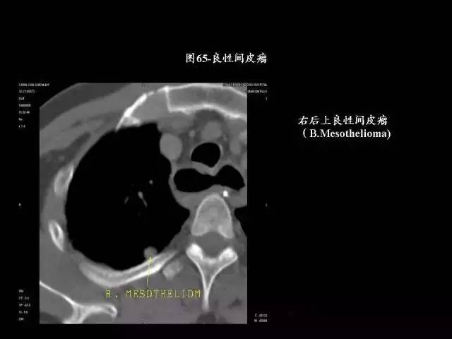常见肺部CT病例读片