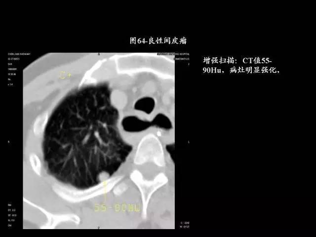 常见肺部CT病例读片