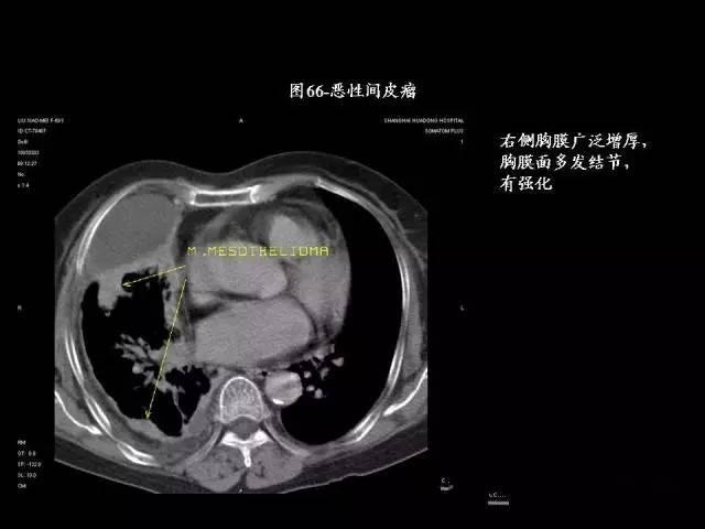 常见肺部CT病例读片