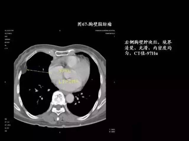 常见肺部CT病例读片