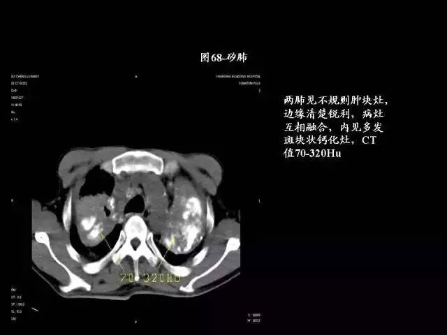 常见肺部CT病例读片