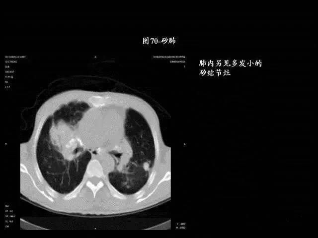 常见肺部CT病例读片