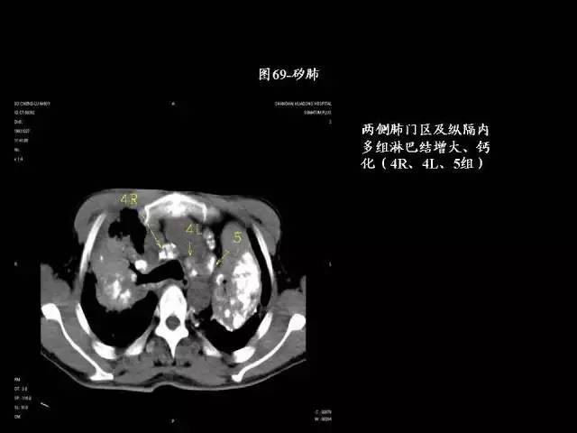 常见肺部CT病例读片
